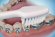 Perfect Smile ortho Brushing steps